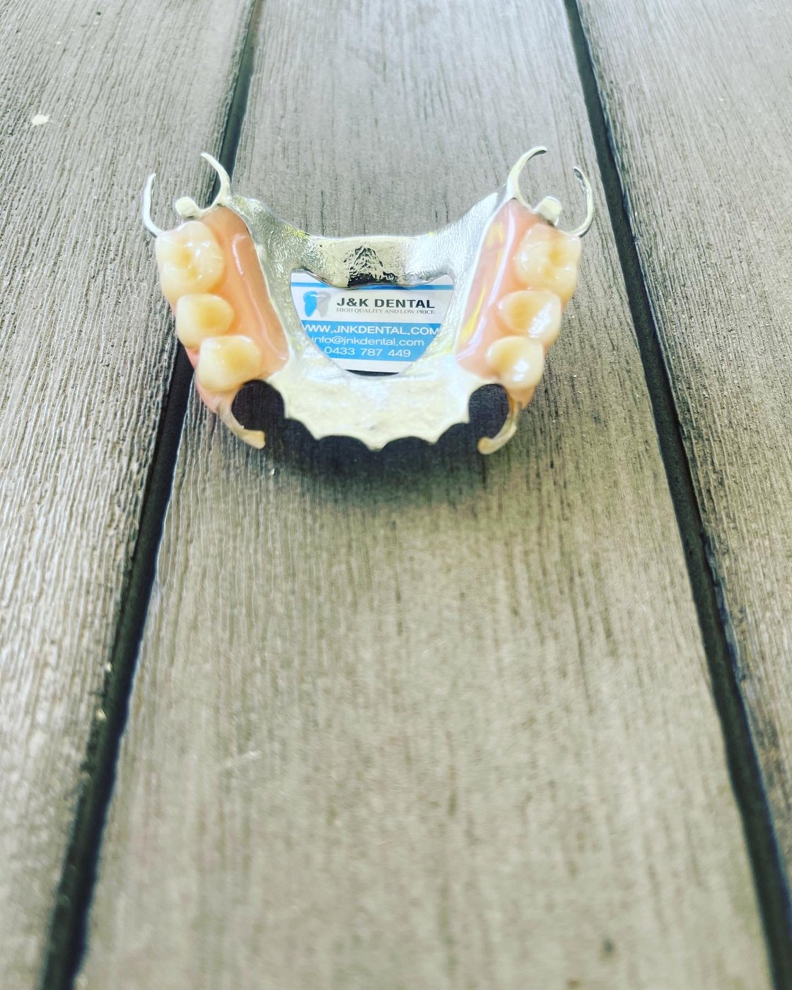 Cast partial denture with metal clasps