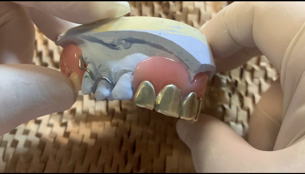 Cast partial denture with gold framework