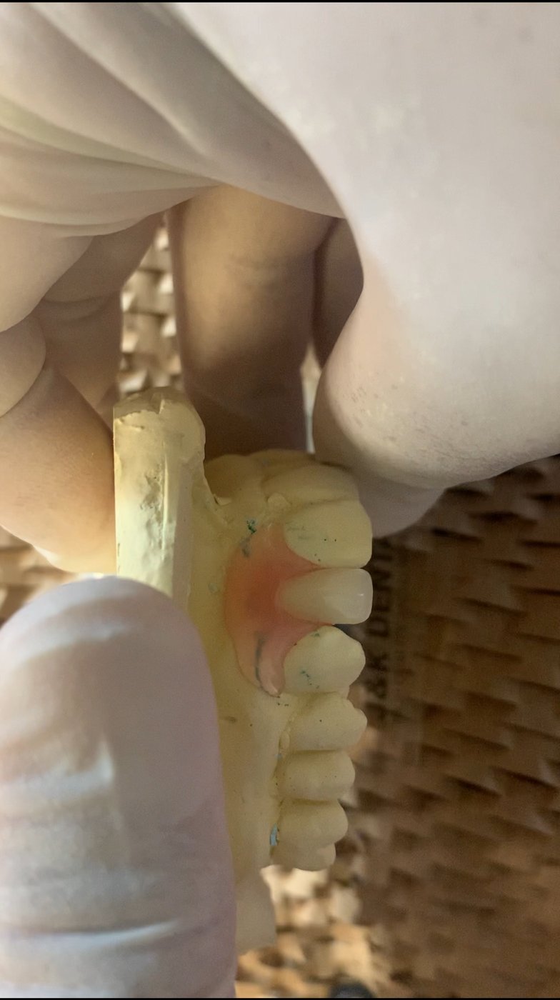 Partial denture detail on model