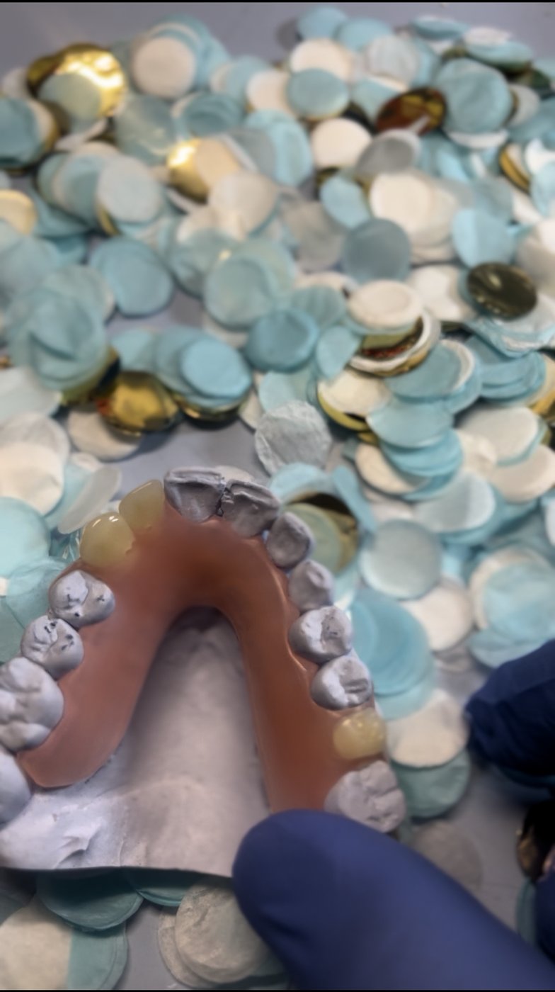 Cobalt chrome partial denture framework detail