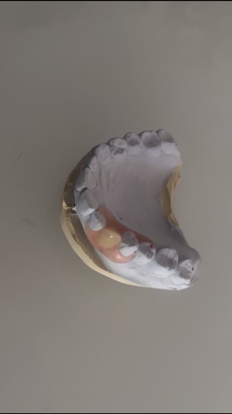 Dental model with partial denture, occlusal view