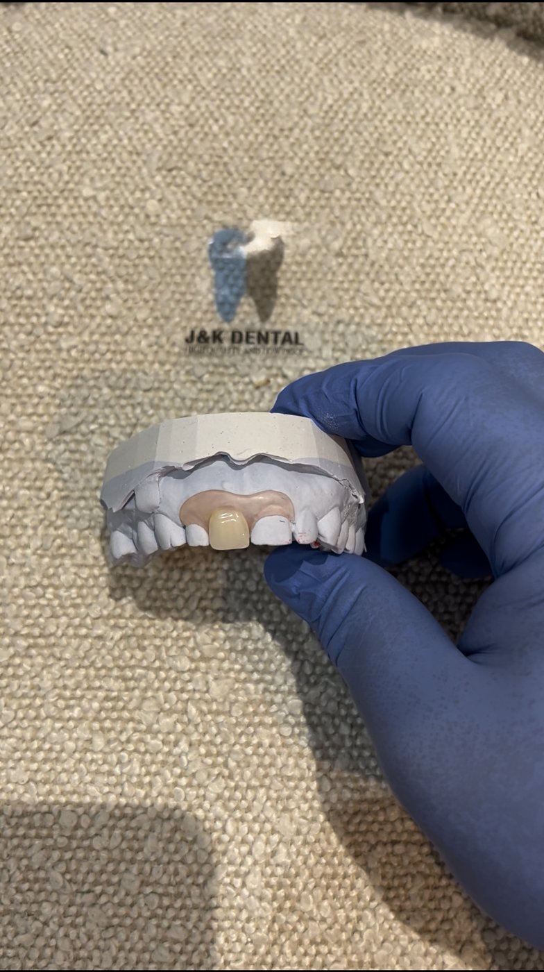 Clear splints on dental models