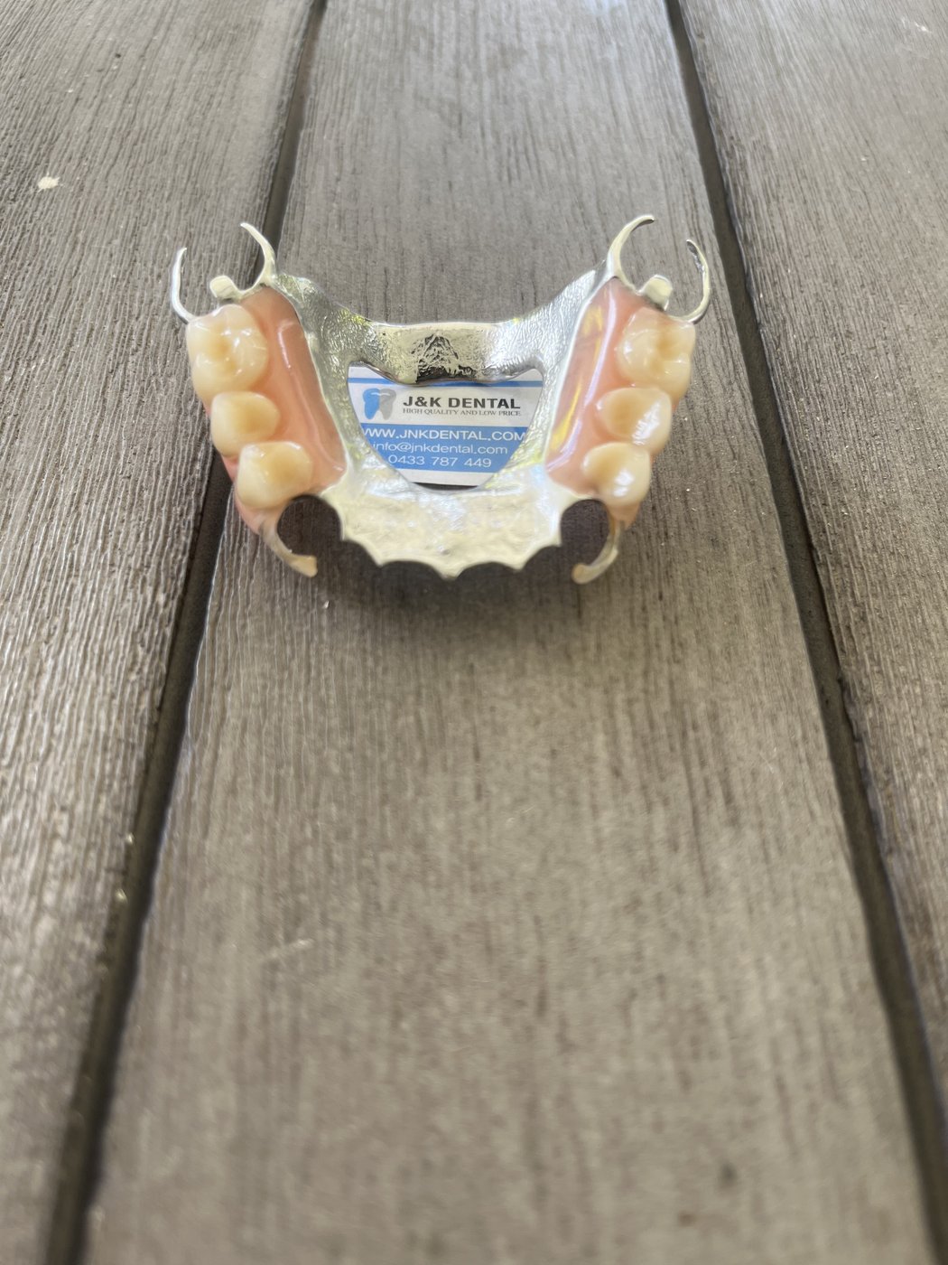 Cast partial denture, occlusal view